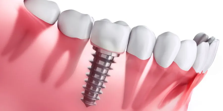 Implante Dentário
