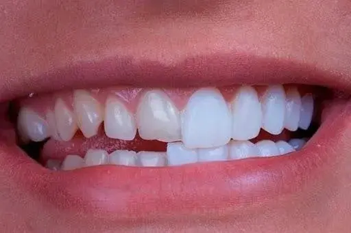 Lentes dentárias