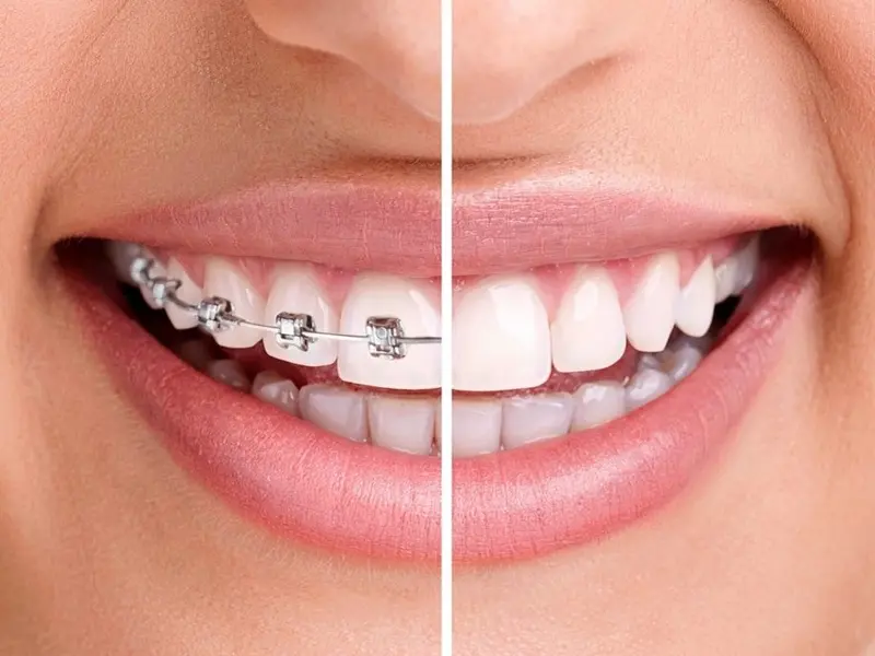 Ortodontia e Invisalign